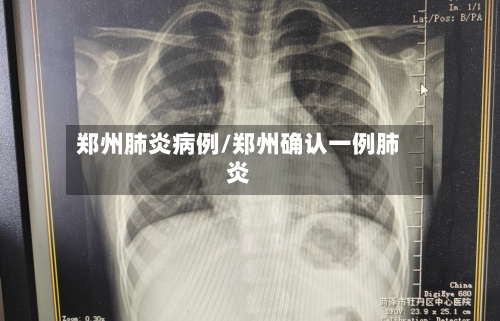 郑州肺炎病例/郑州确认一例肺炎