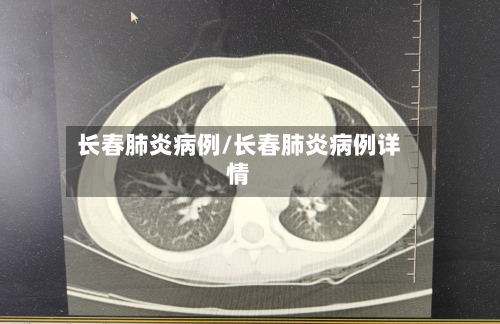 长春肺炎病例/长春肺炎病例详情