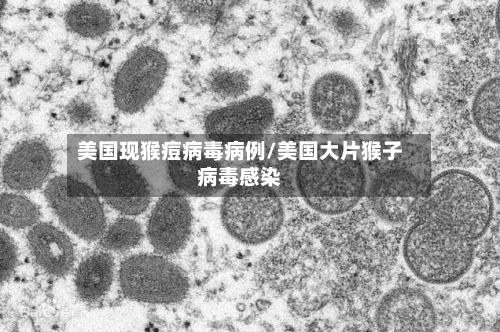 美国现猴痘病毒病例/美国大片猴子病毒感染